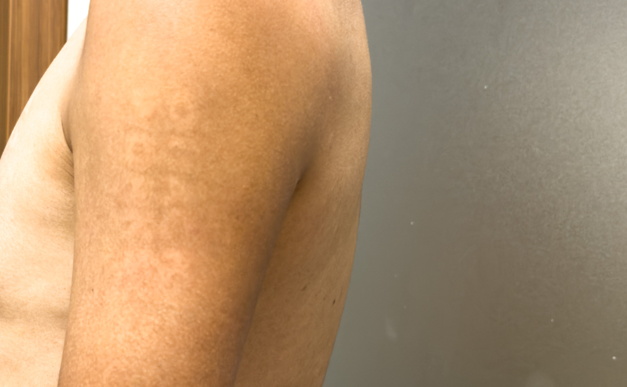 肌にカッティングシートは貼れるのか。そして日焼け跡はできるのかの実験